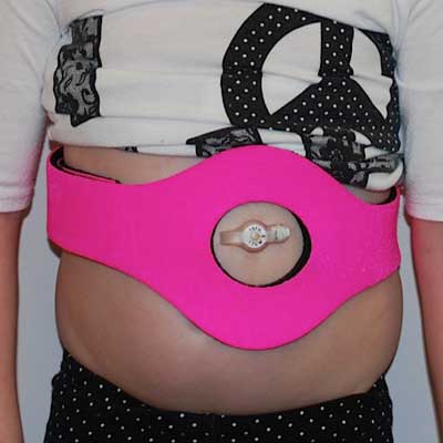 G-Tube Protective Wrap with Button Uncovered
